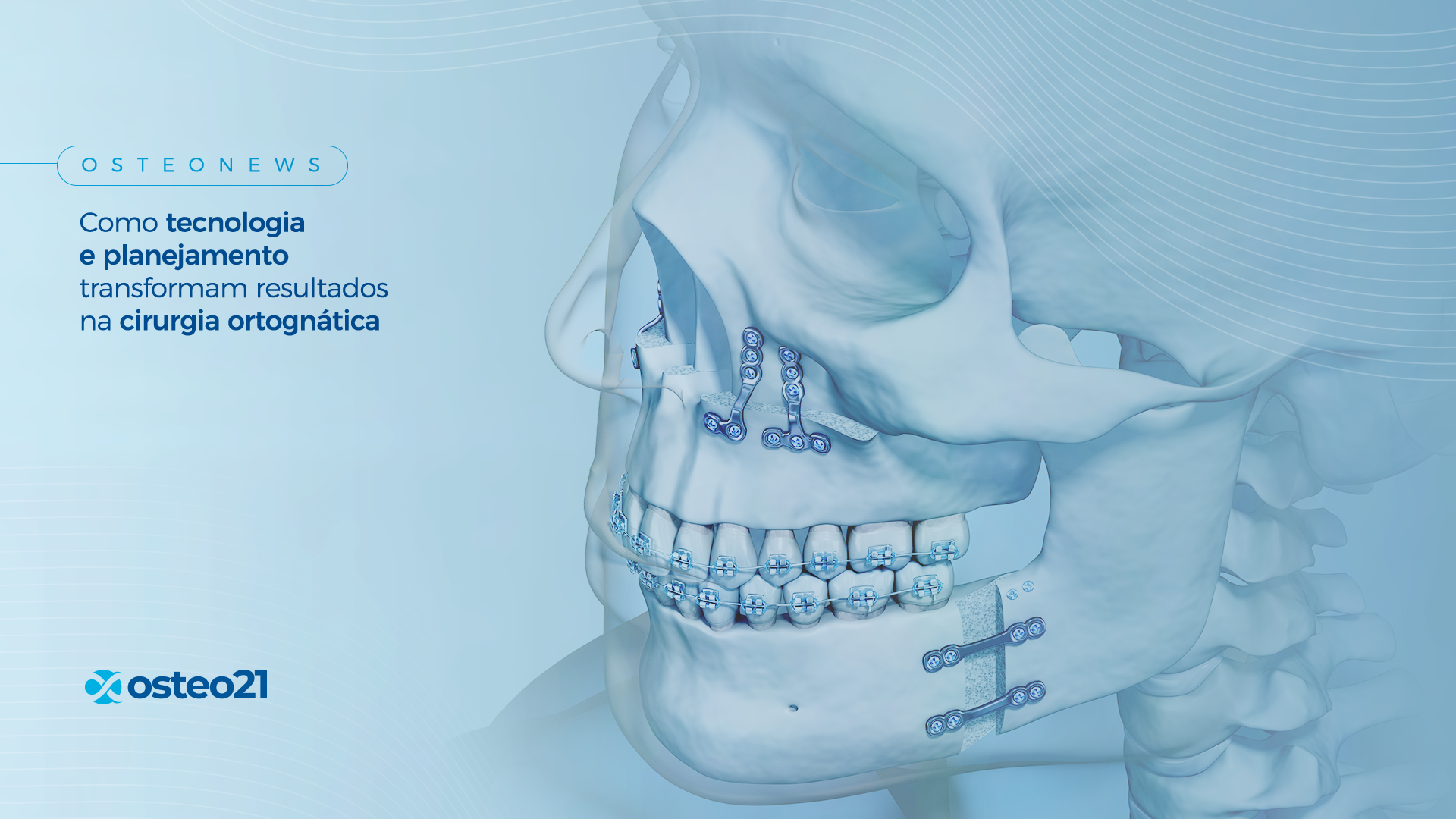 Como tecnologia e planejamento transformam resultados na cirurgia ortognática
