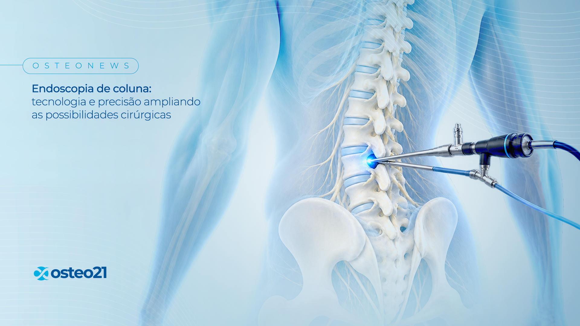 Endoscopia de coluna: tecnologia e precisão ampliando as possibilidades cirúrgicas