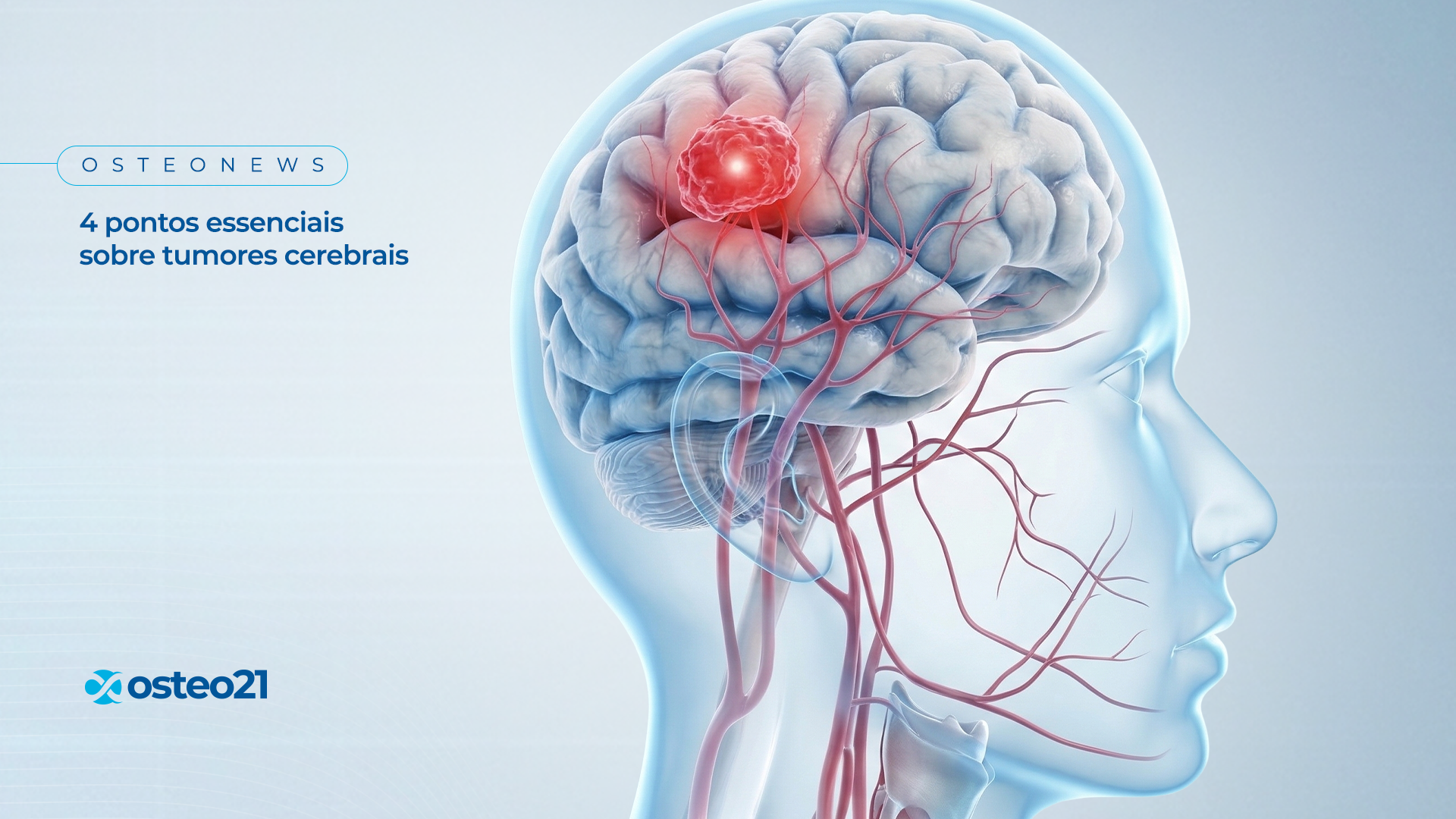 4 pontos essenciais sobre tumores cerebrais